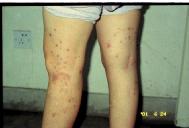 一名法轮功学员在北京一看守遭受电针酷刑后腿上留下的疤痕
