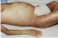 肖劲松被迫害得骨瘦如柴，腹部、大腿根部肿大。