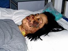 高蓉蓉二零零四年五月七日被酷刑折磨，脸上是电烧灼伤。照片是受伤十天后拍摄的。
