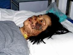 高蓉蓉2004年5月7日被恶警电击灼伤。照片是受伤10天后拍摄的。