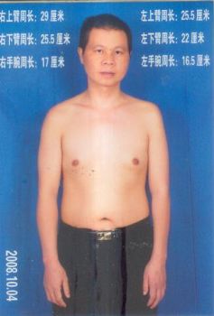 岳阳孙平华被酷刑折磨后，左手臂肌肉萎缩