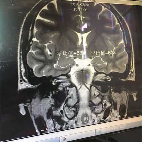 '图2：医院做核磁共振检查显示“脑部杏仁核肿大”。'