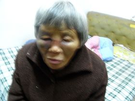 王柳珍的鼻梁被监控她的恶徒打断，双眼被打得青肿，睁不开。