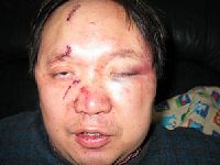 李渊博士，2月8日在家里遭持枪歹徒袭击，脸上缝了15针。
