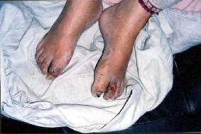񟭂年9月—2004年9月王良均在都匀监狱被残酷迫害后留下的伤痕'